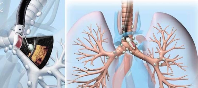 Endo-Bronchial-Ultrasound